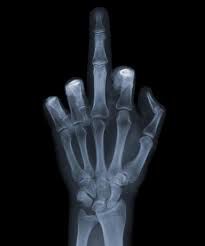 x-ray/srednji prst